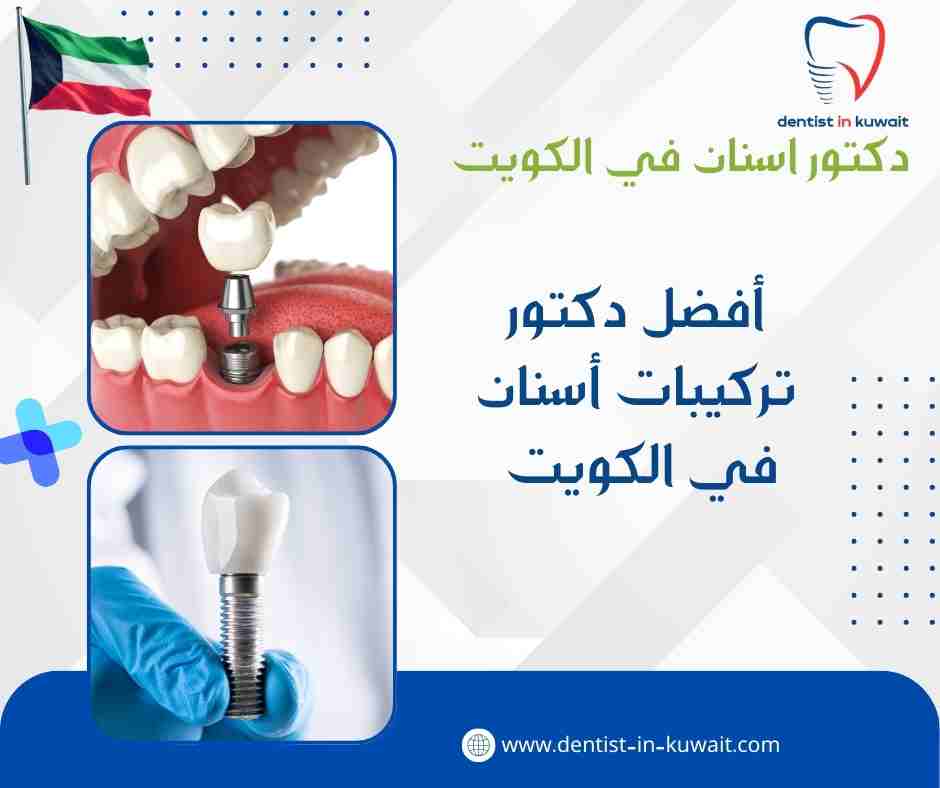 أفضل دكتور تركيبات أسنان في الكويت