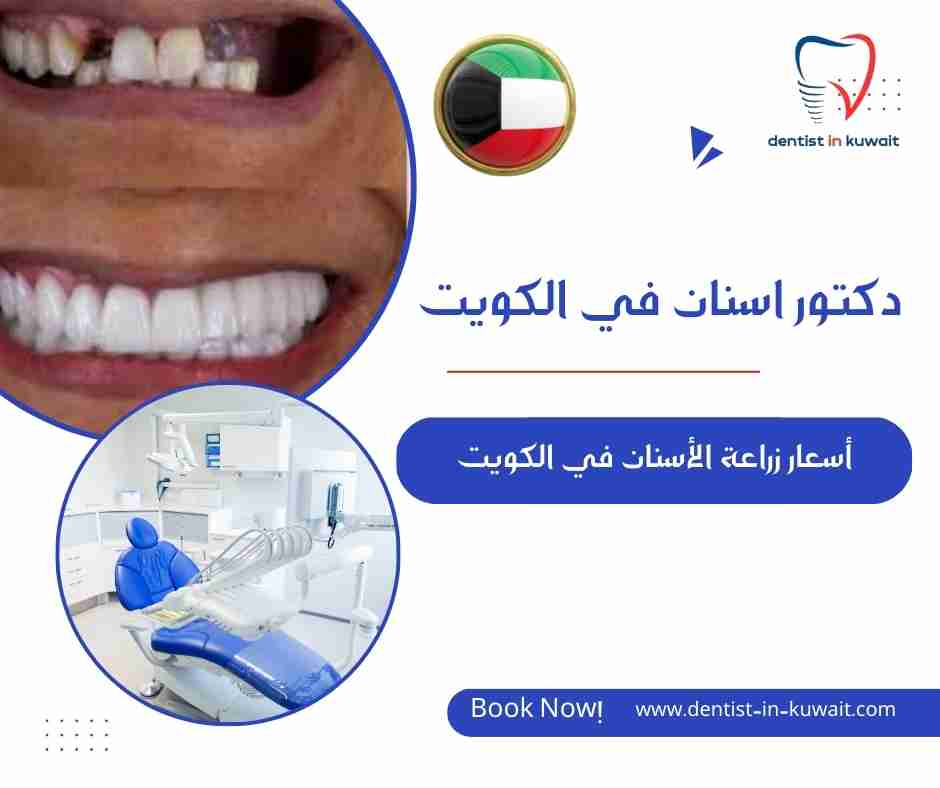 أسعار زراعة الأسنان في الكويت