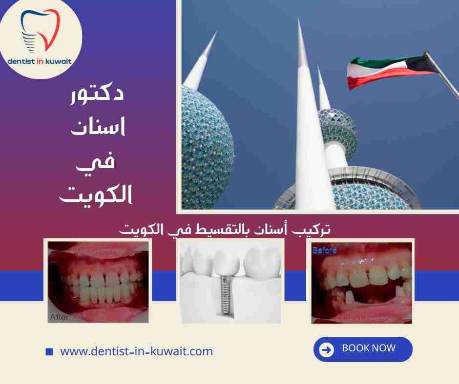 تركيب أسنان بالتقسيط في الكويت