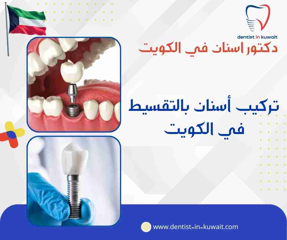 تركيب أسنان بالتقسيط في الكويت