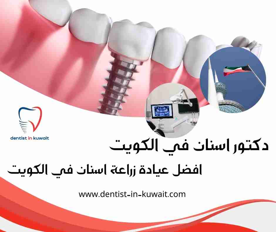 افضل عيادة زراعة اسنان في الكويت
