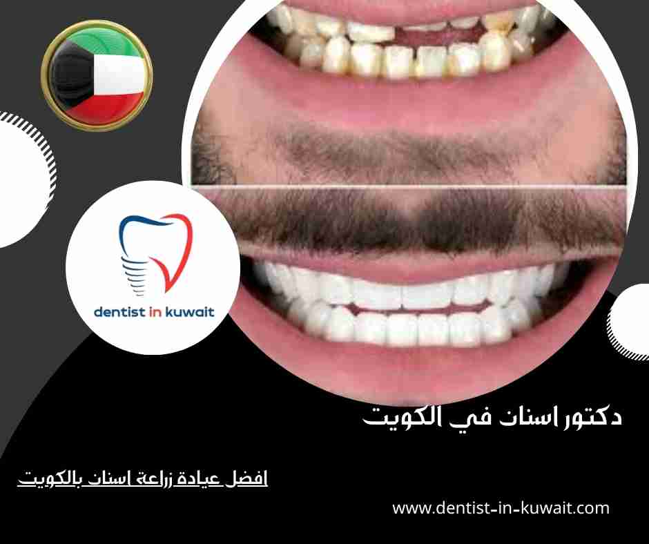 افضل عيادة زراعة اسنان بالكويت