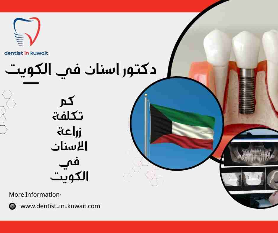 كم تكلفة زراعة الاسنان في الكويت