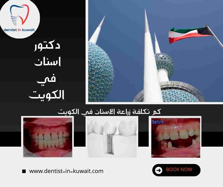 كم تكلفة زراعة الاسنان في الكويت