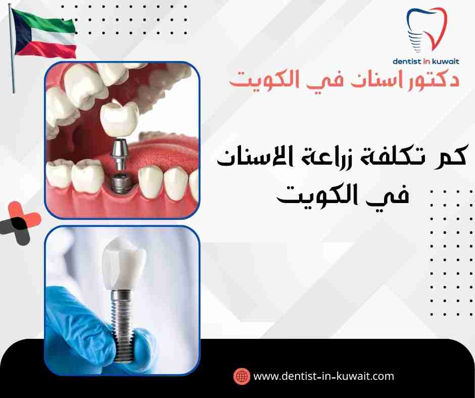 كم تكلفة زراعة الاسنان في الكويت