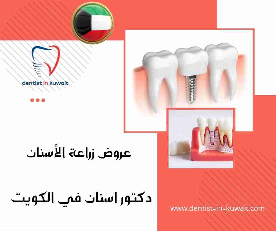 عروض زراعة الأسنان