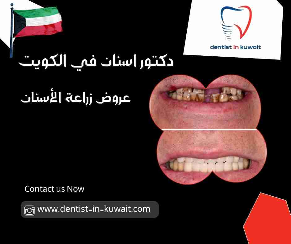 عروض زراعة الأسنان