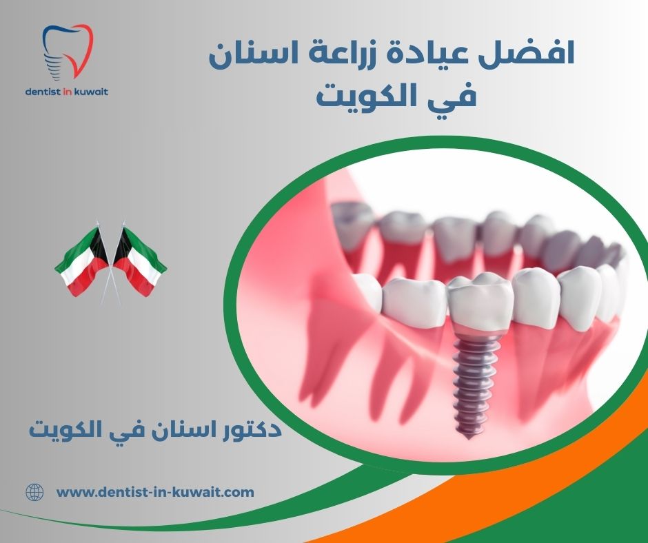 أسعار زراعة الأسنان في الكويت أسعار زراعة الأسنان في الكويت