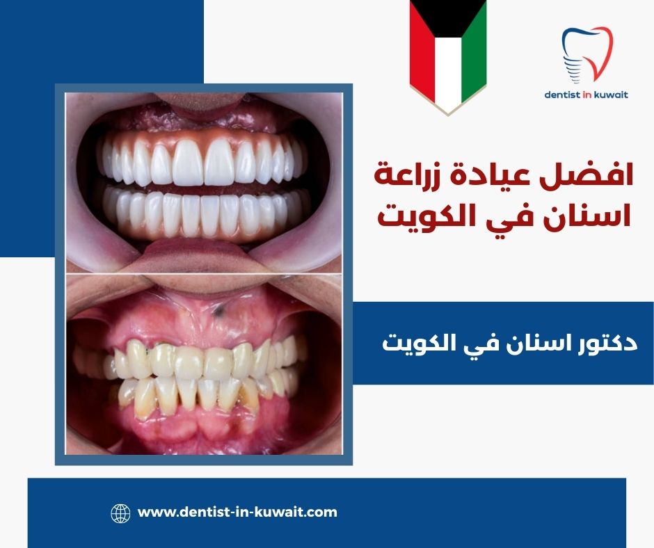 افضل عيادة زراعة اسنان في الكويت