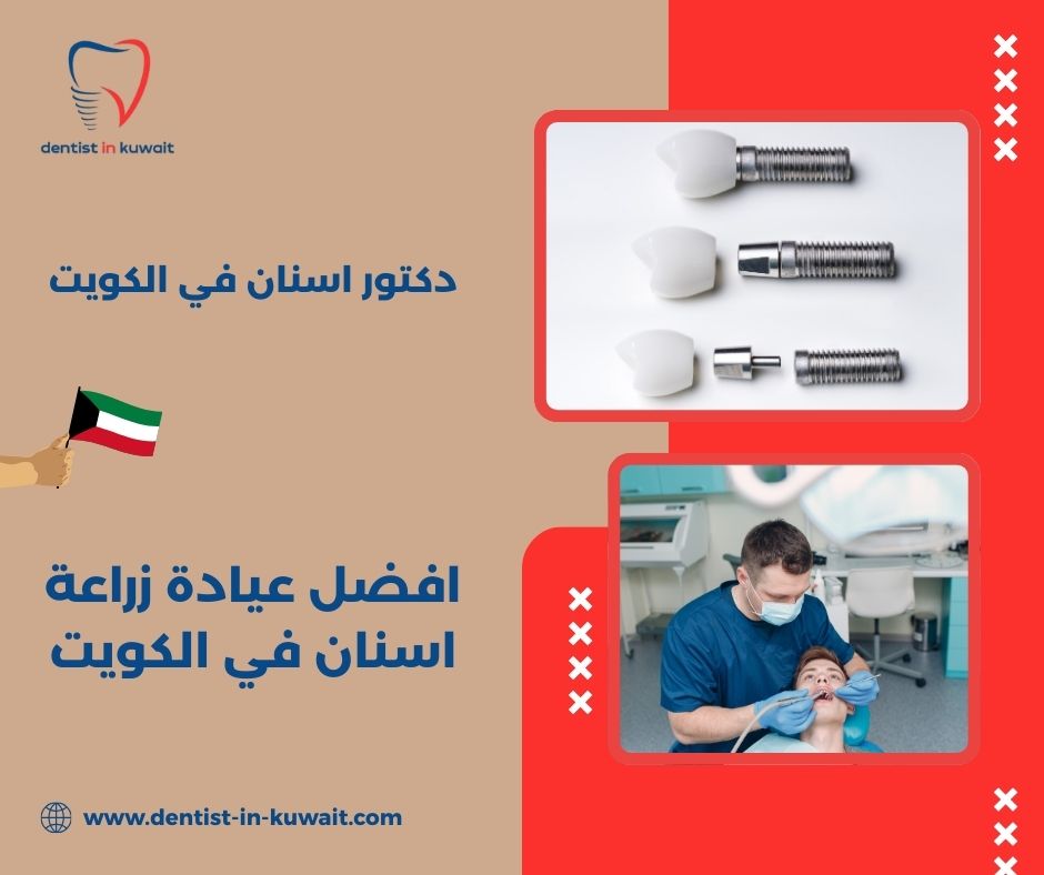 افضل عيادة زراعة اسنان في الكويت افضل عيادة زراعة اسنان في الكويت