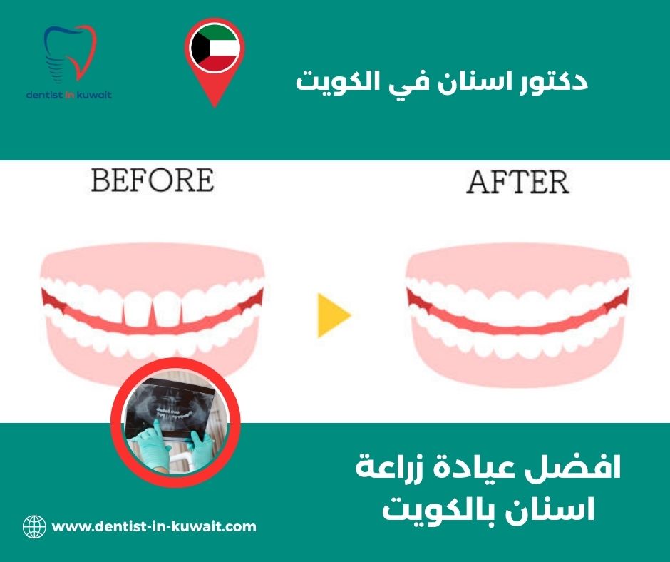 افضل عيادة زراعة اسنان بالكويت