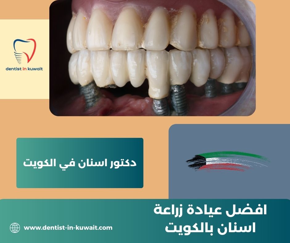أفضل عيادة زراعة أسنان في الكويت