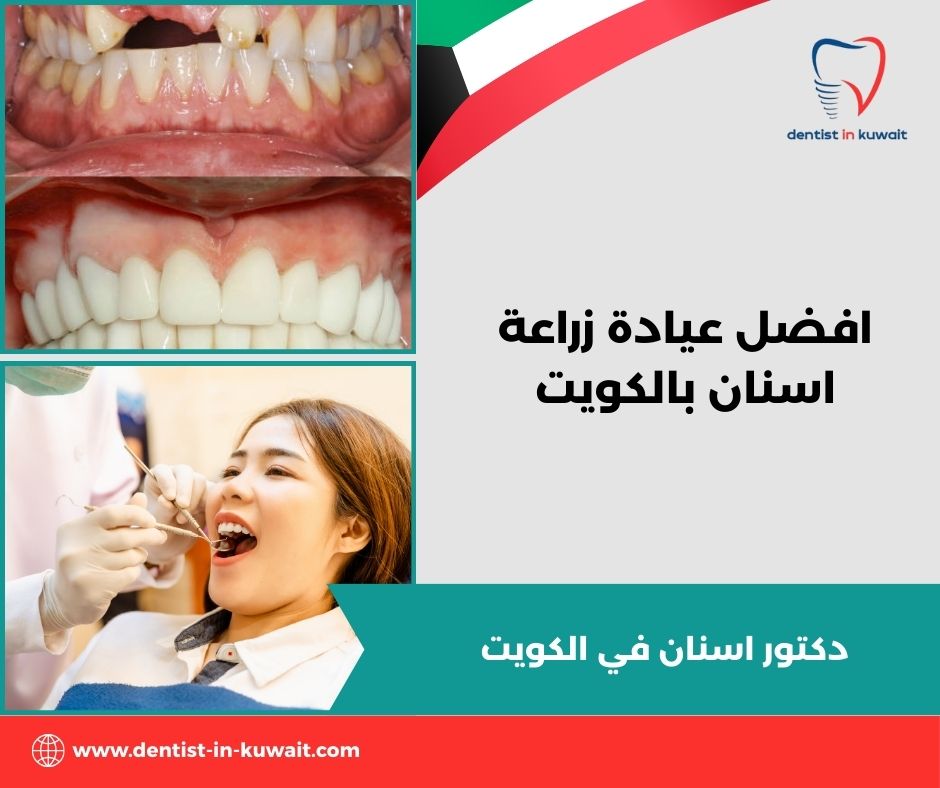افضل عيادة زراعة اسنان بالكويت