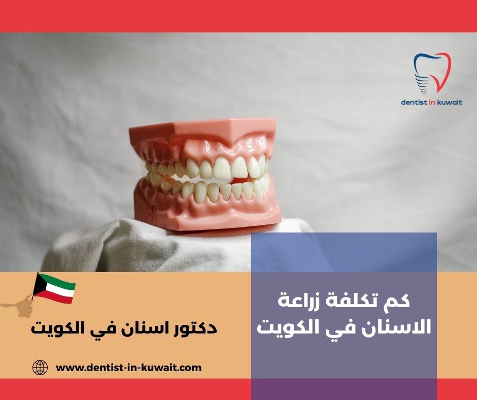 تكلفة زراعة الاسنان بالكويت