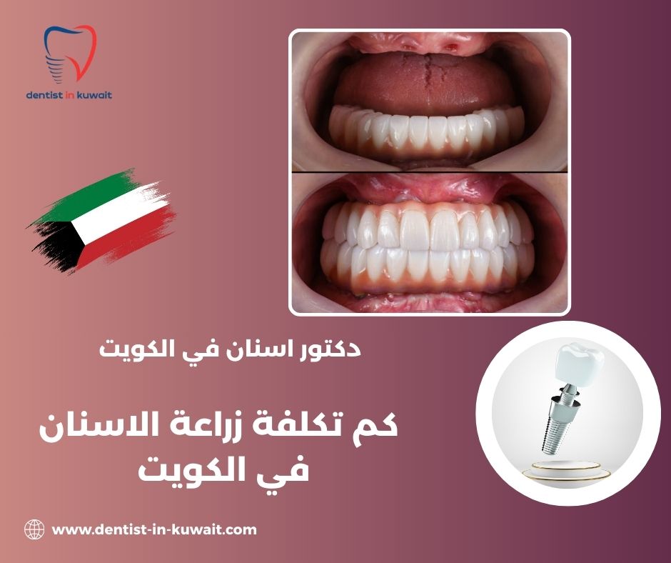 تكلفة زراعة الأسنان في الكويت