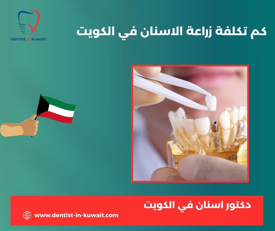 أسعار زراعة الأسنان في الكويت 2024
