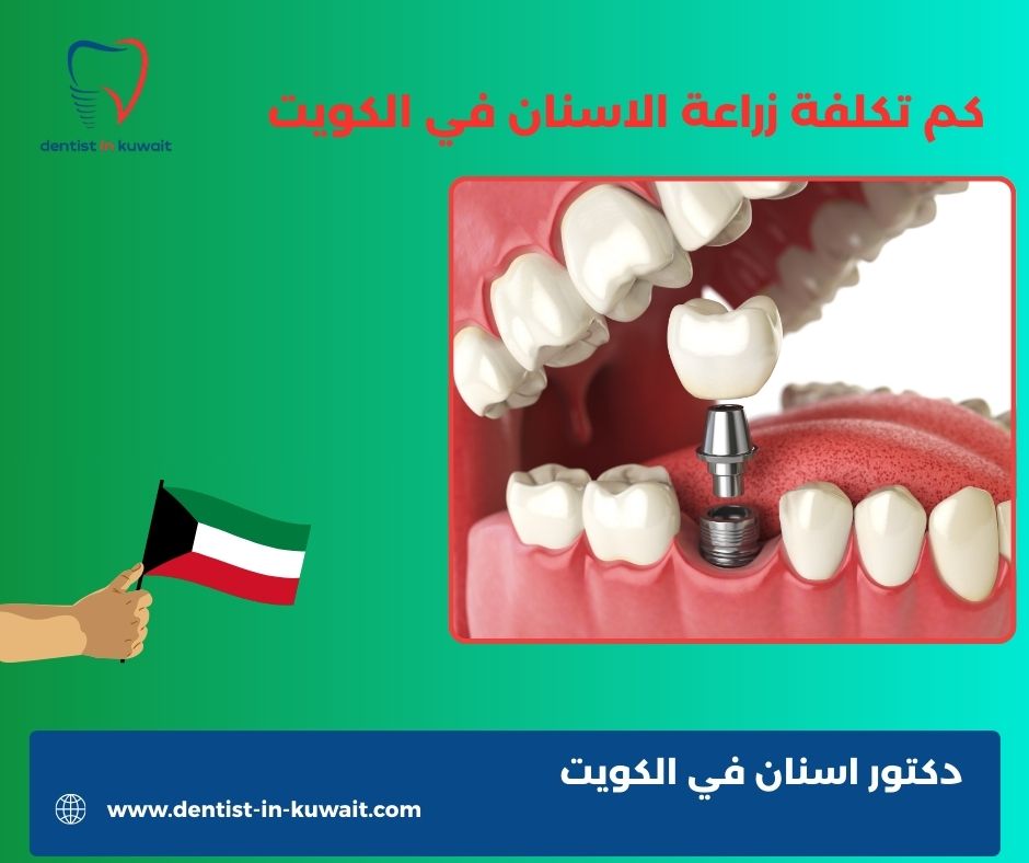 أسعار زراعة الأسنان في الكويت