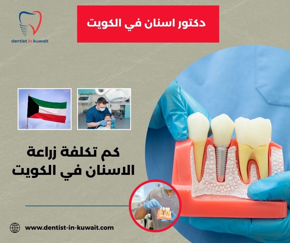كم تكلفة زراعة الاسنان في الكويت