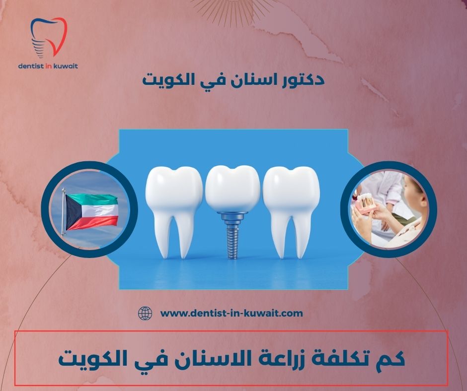 كم تكلفة زراعة الاسنان في الكويت