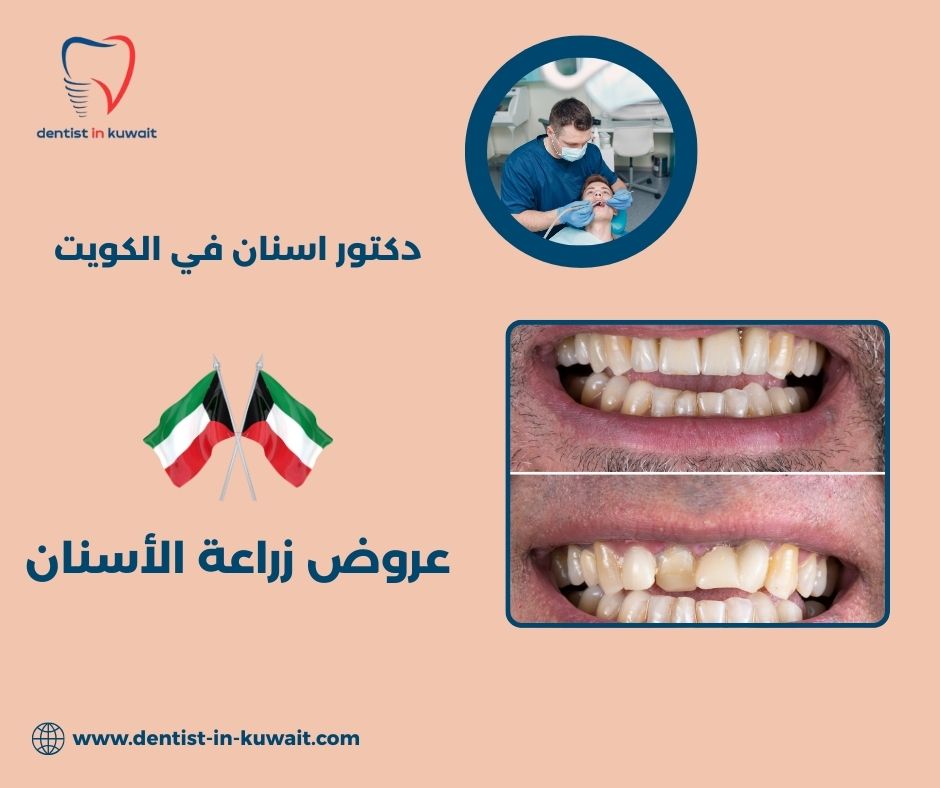 عروض زراعة الأسنان