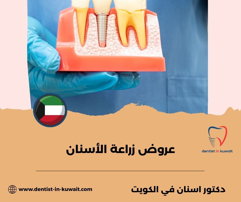 زراعة الأسنان في الكويت