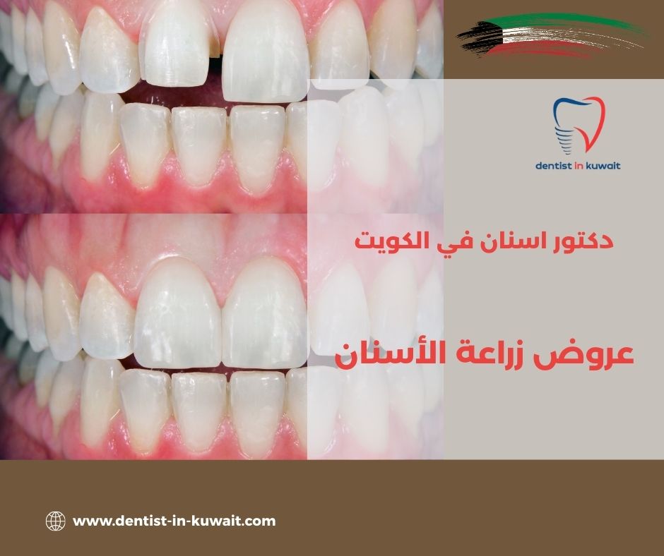 أرخص زراعة أسنان بالكويت