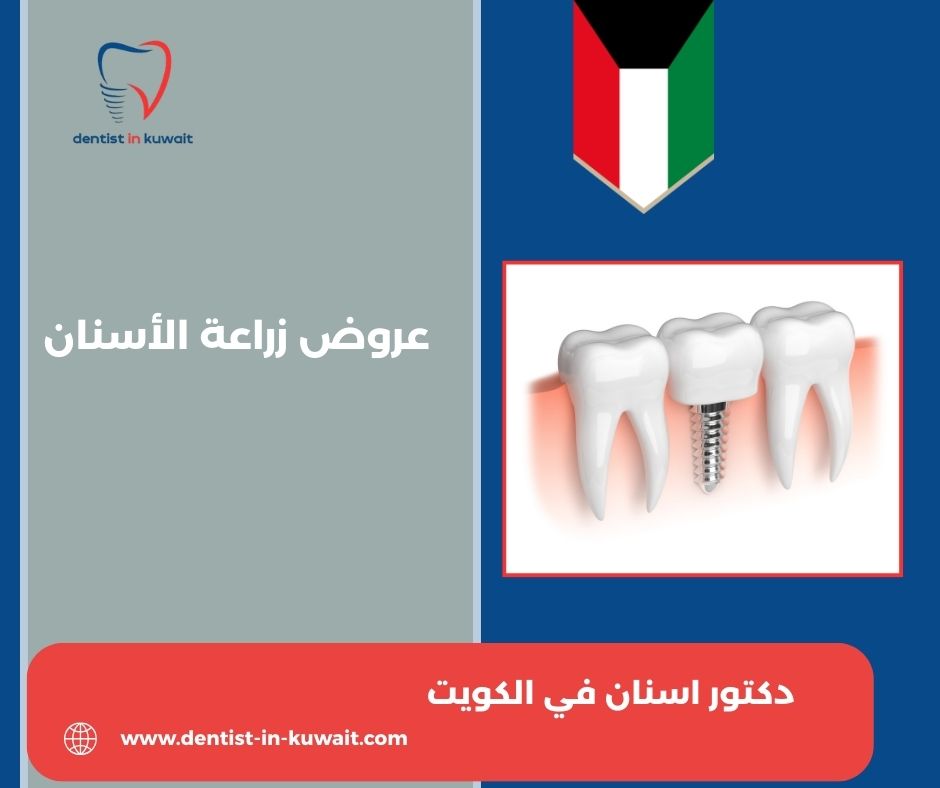 أسعار زراعة الأسنان في الكويت
