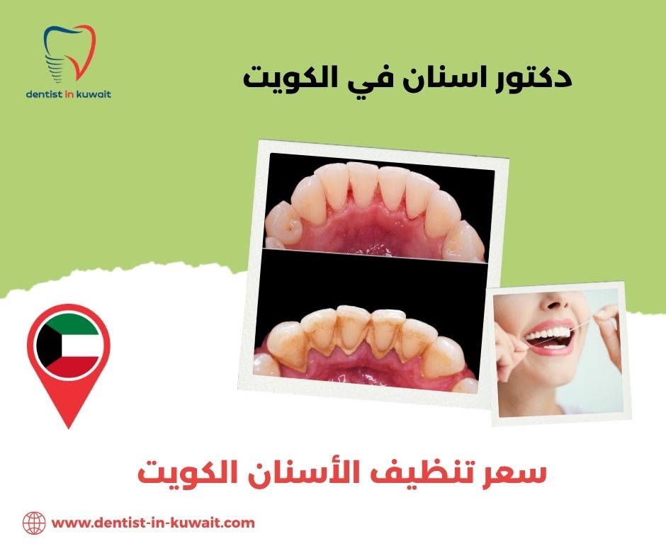 أسعار تنظيف الأسنان في الكويت