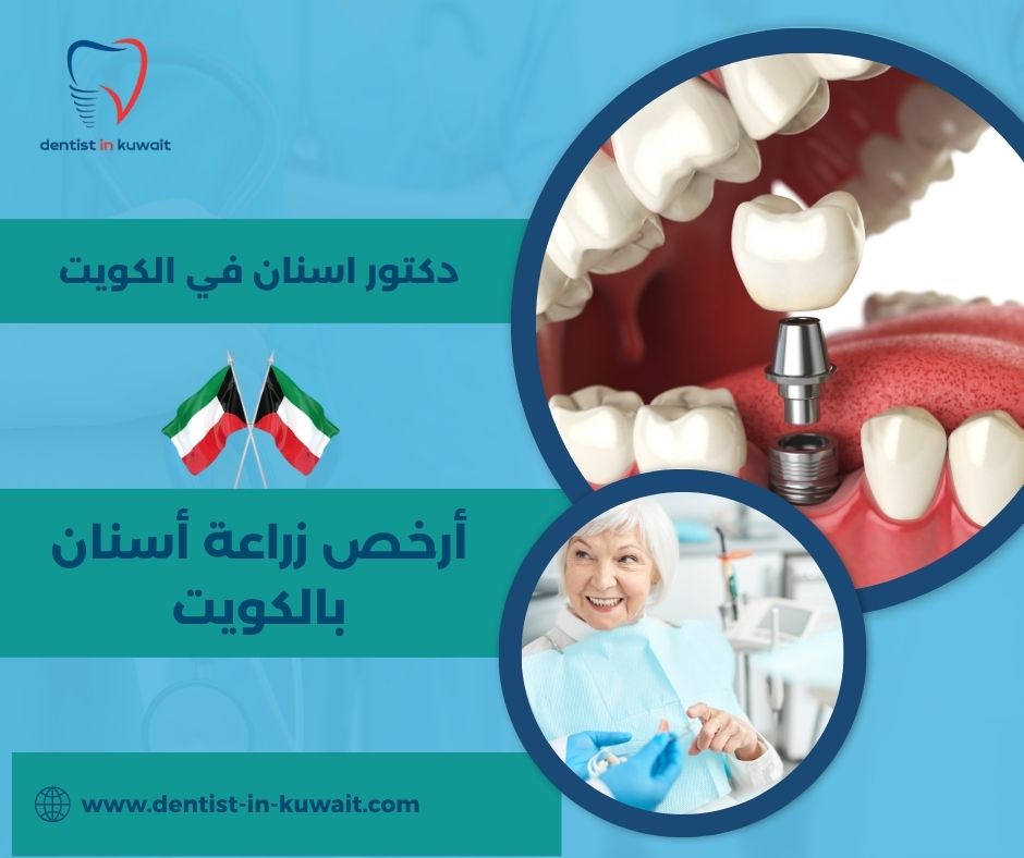أرخص زراعة أسنان بالكويت