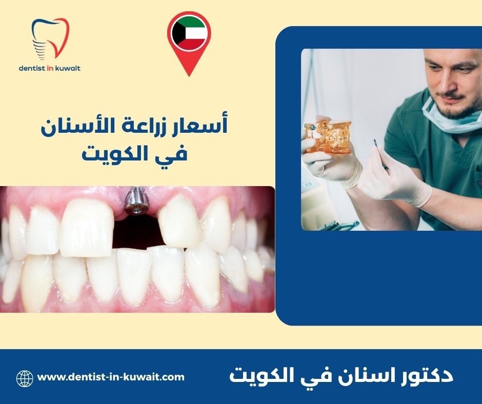 أسعار زراعة الأسنان في الكويت أسعار زراعة الأسنان في الكويت