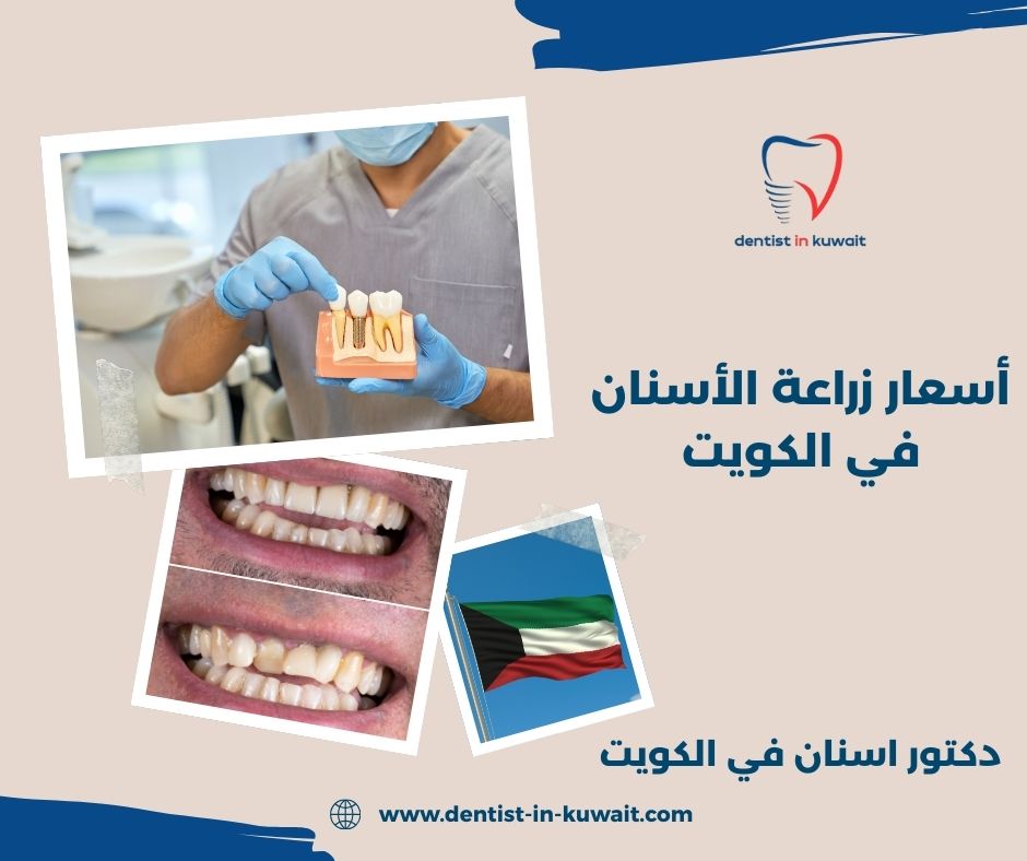 أسعار زراعة الأسنان في الكويت
