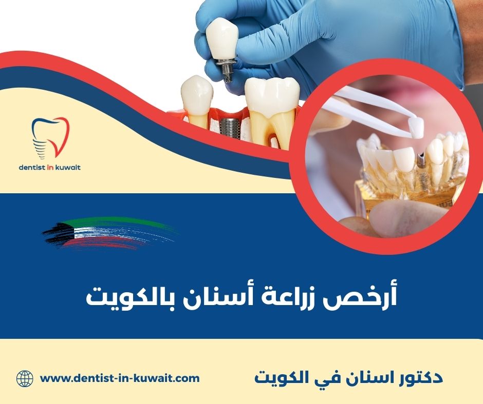 زراعة الأسنان في الكويت