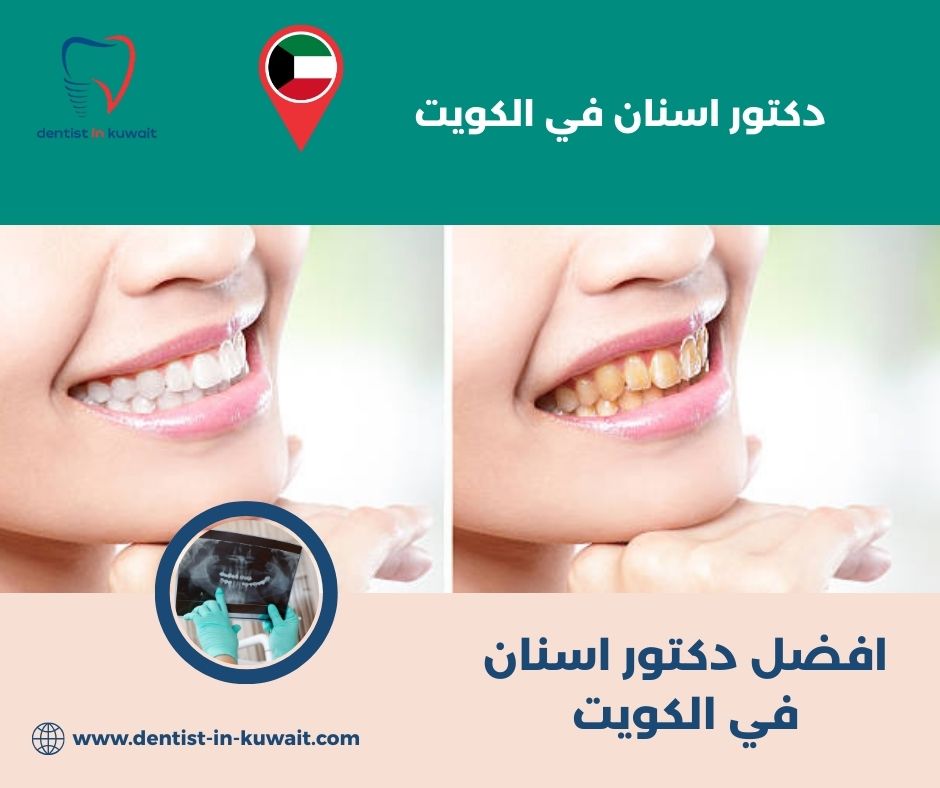 افضل دكتور عصب اسنان في الكويت