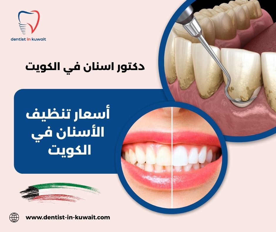 أسعار تنظيف الأسنان في الكويت