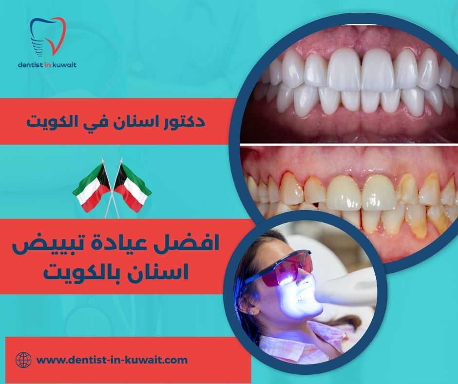 افضل عيادة تبييض اسنان بالكويت