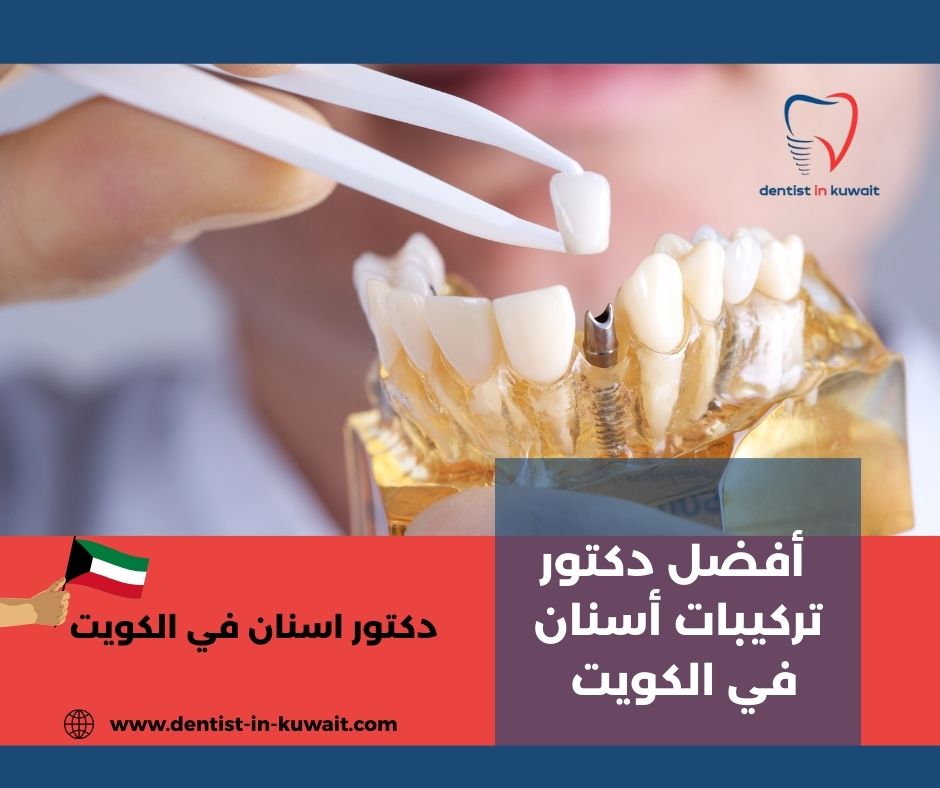 افضل دكتور عصب اسنان في الكويت