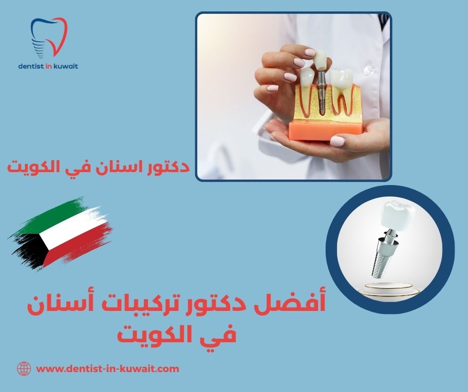 أفضل دكتور زراعة أسنان في الكويت