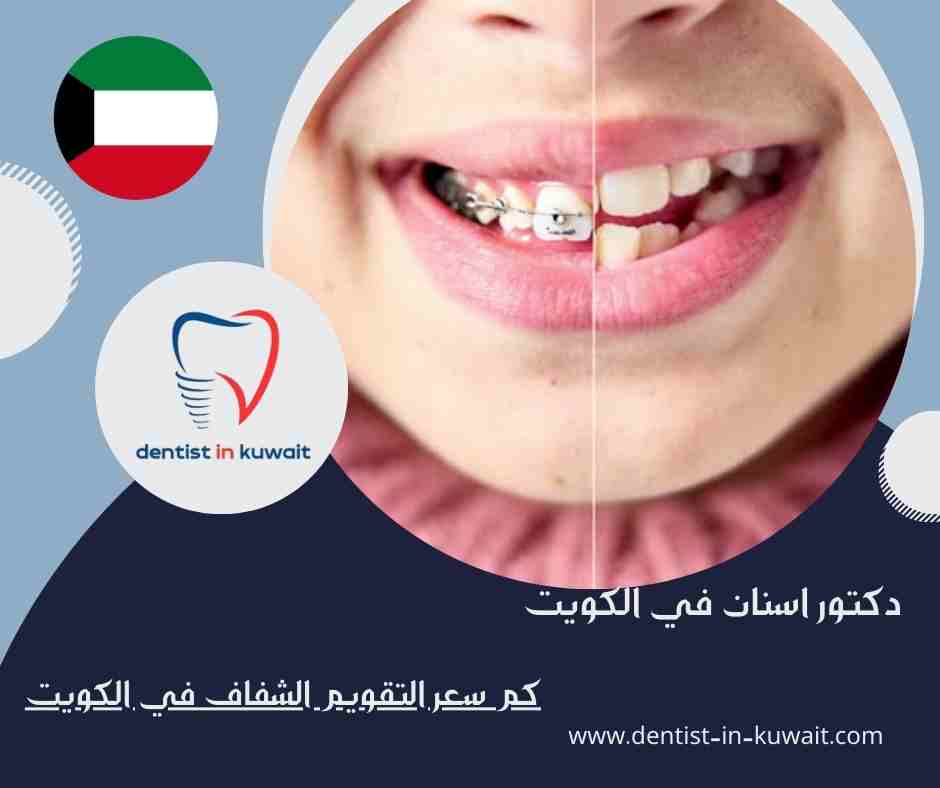 كم سعر التقويم الشفاف في الكويت