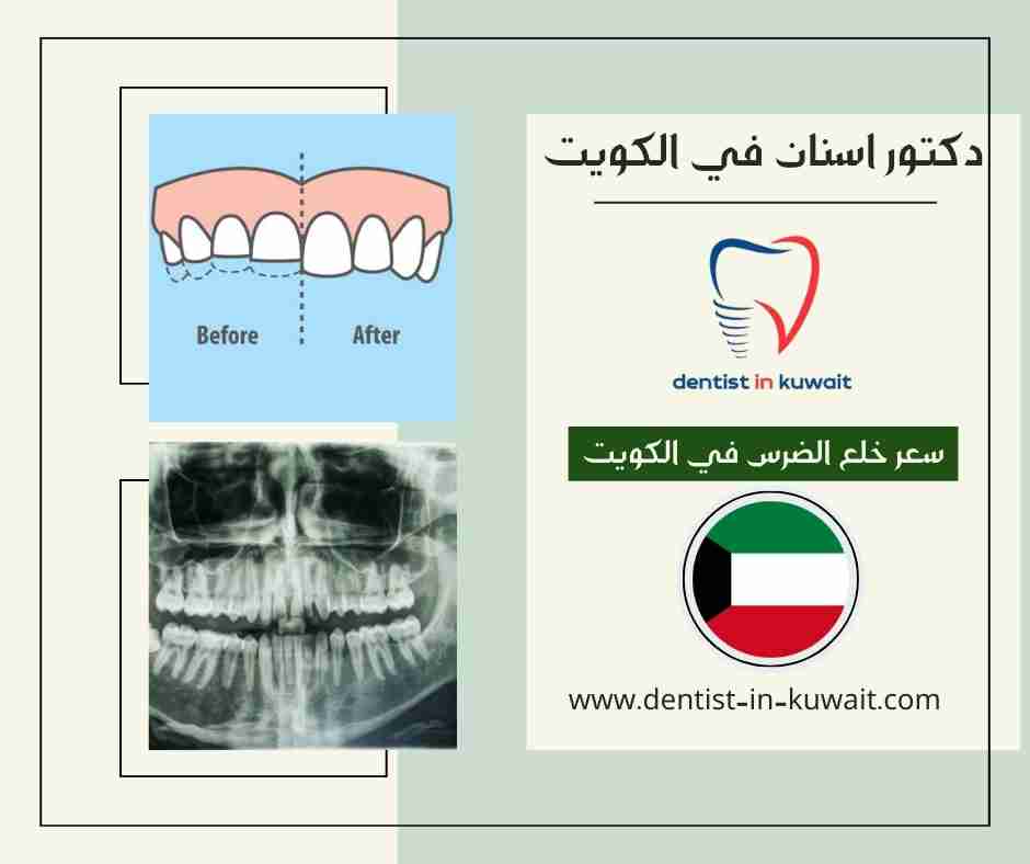 سعر خلع الضرس في الكويت