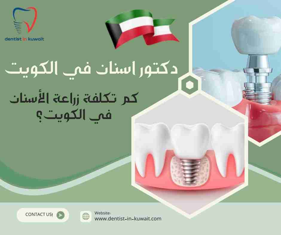 كم تكلفة زراعة الأسنان في الكويت؟