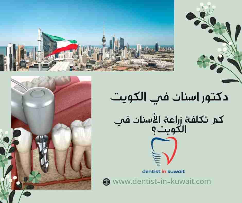 كم تكلفة زراعة الأسنان في الكويت؟