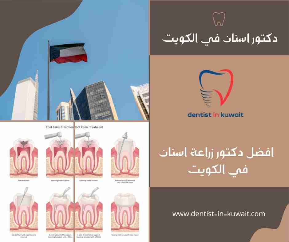 افضل دكتور زراعة اسنان في الكويت