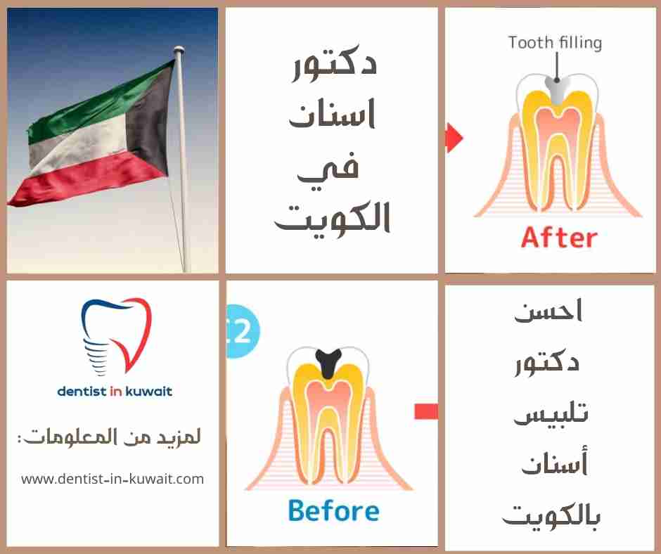 احسن دكتور تلبيس أسنان بالكويت