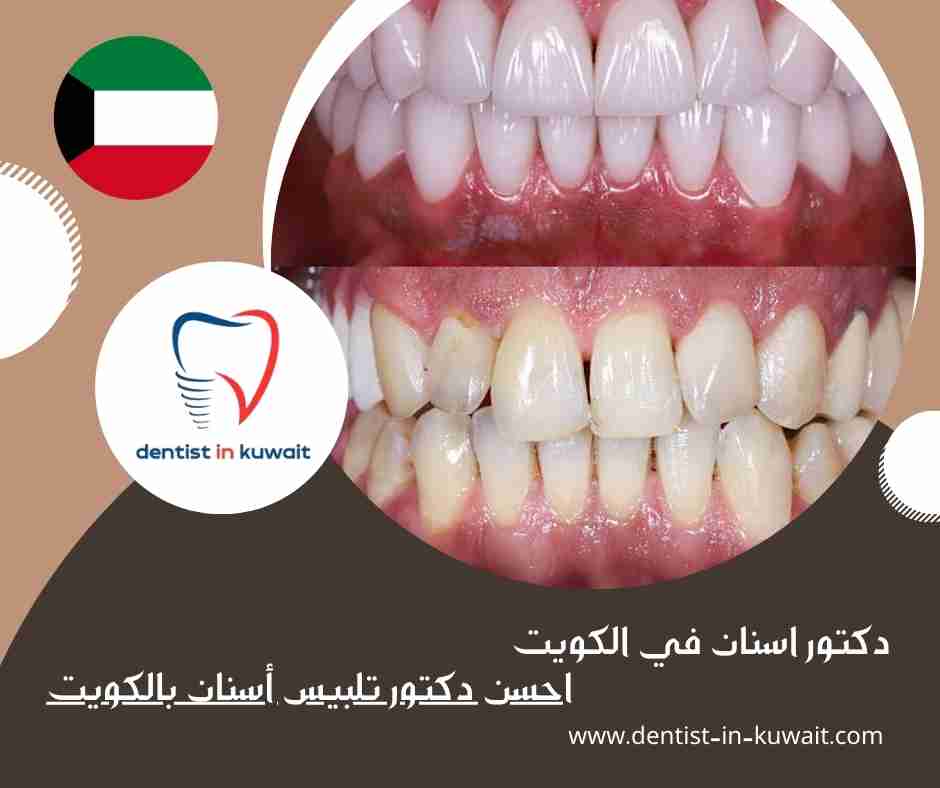 احسن دكتور تلبيس أسنان بالكويت