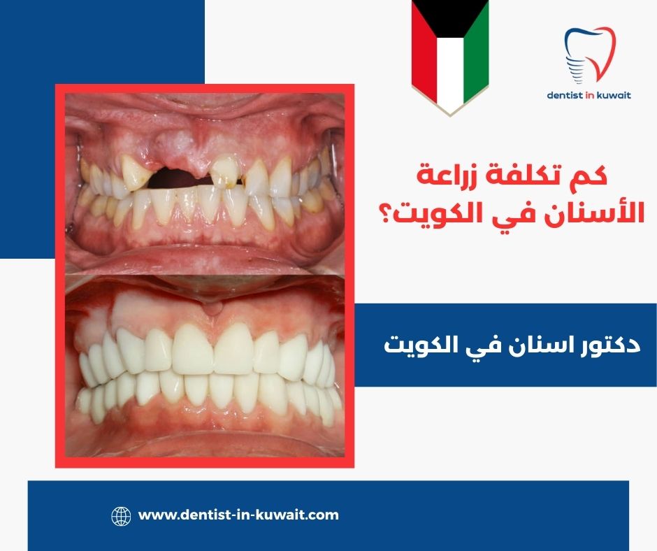 كم تكلفة زراعة الأسنان في الكويت؟