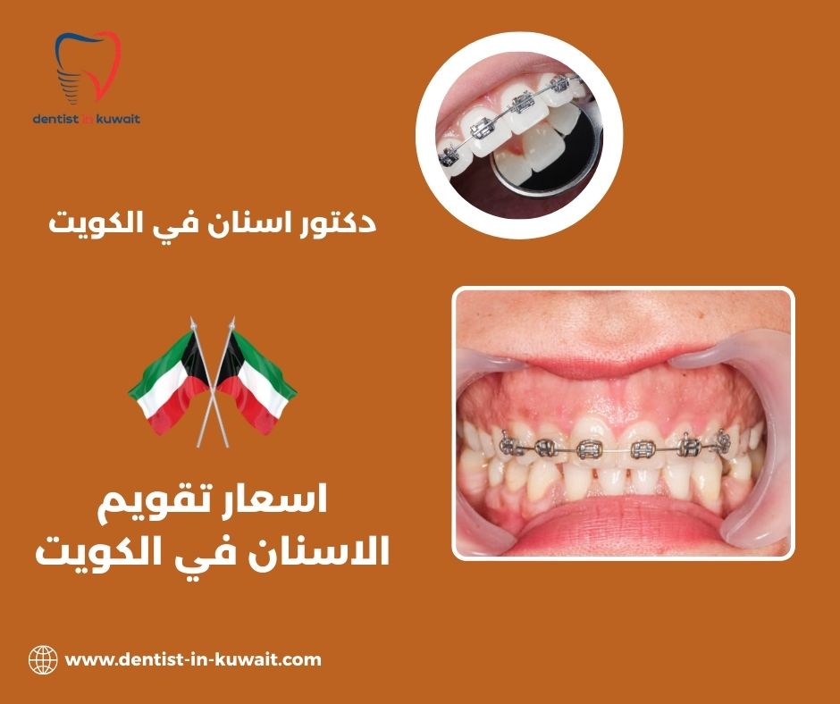 اسعار تركيب تقويم الاسنان في الكويت