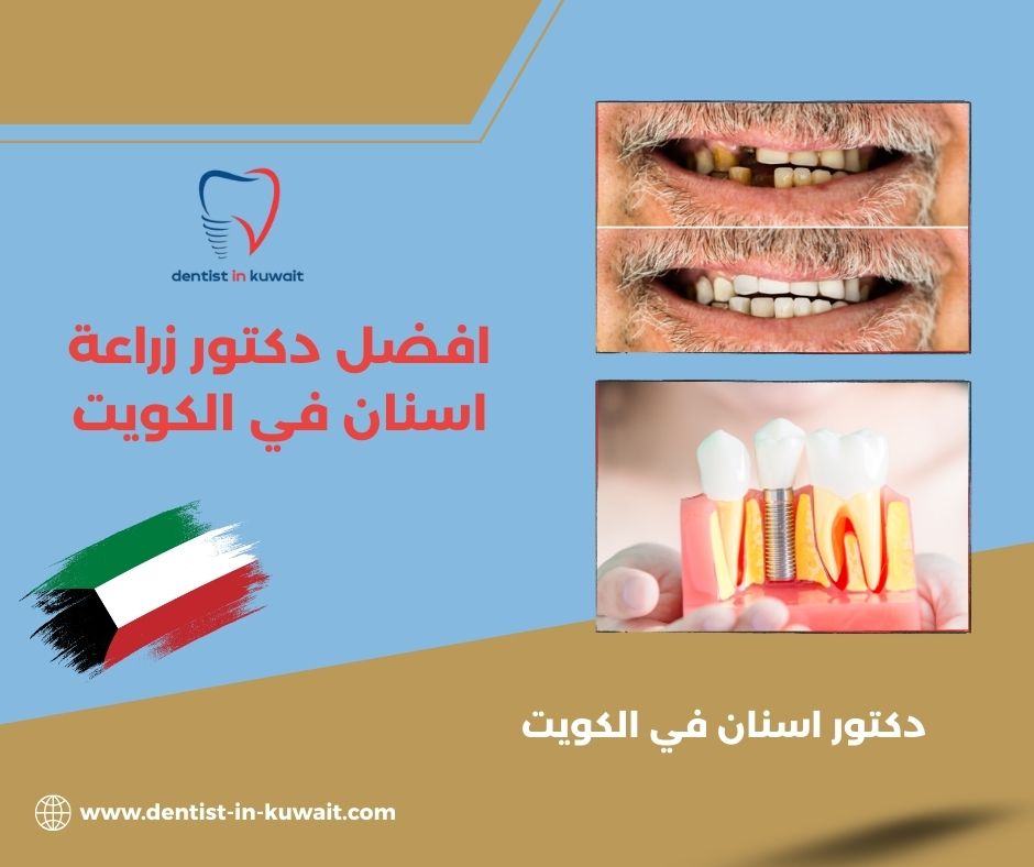 افضل دكتور زراعة اسنان في الكويت