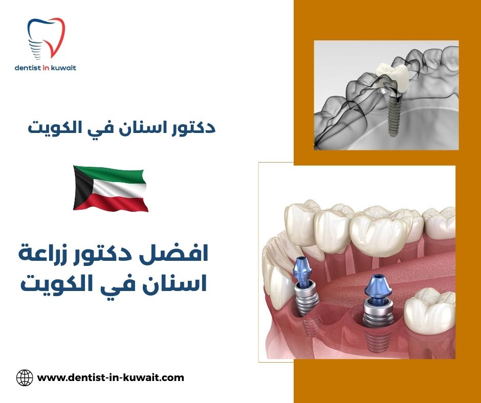 افضل دكتور زراعه اسنان بالكويت افضل دكتور زراعه اسنان بالكويت