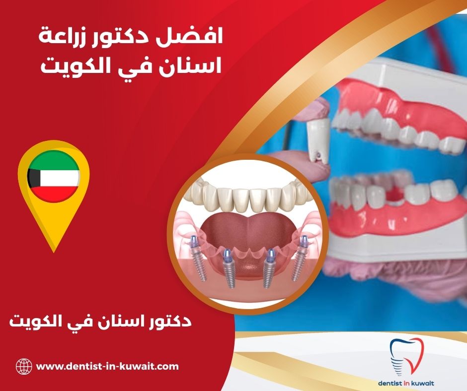 افضل دكتور زراعة اسنان بالكويت افضل دكتور زراعة اسنان بالكويت