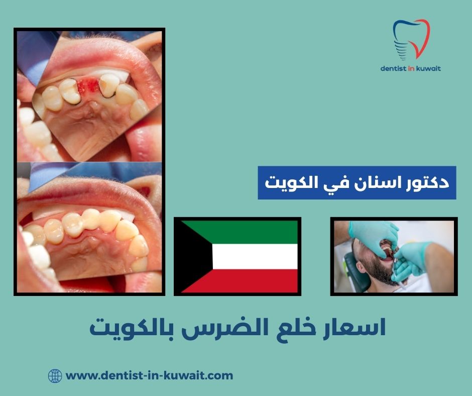 اسعار خلع الضرس بالكويت